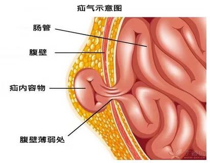 全国疝气最新治疗技术，革新与进步推动患者康复之路